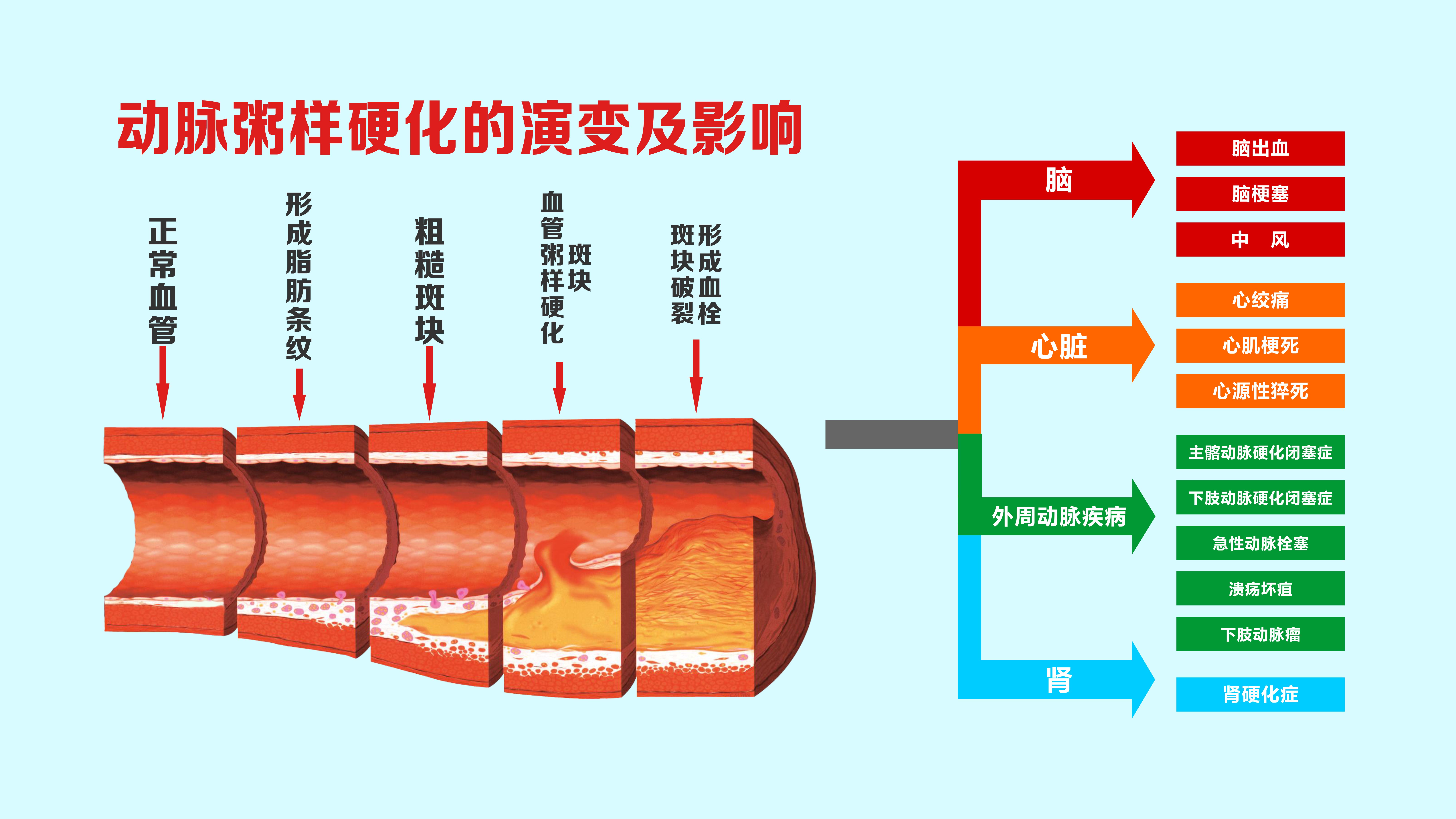 23.动脉硬化的演变及影响.jpg