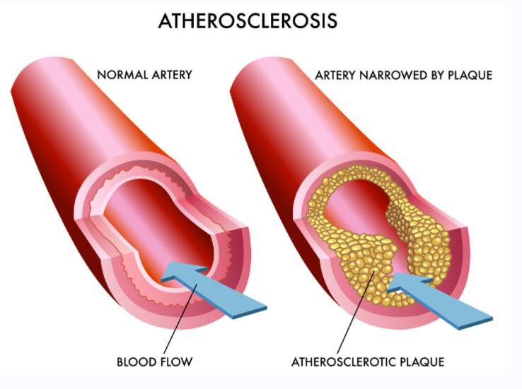 动脉粥样硬化.jpg